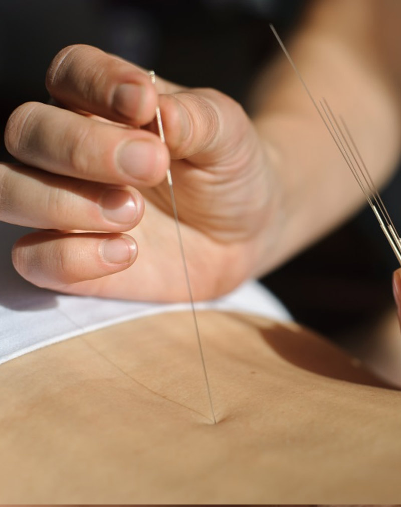 Best Acupuncture in RR Nagar