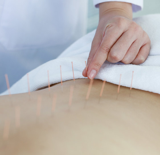 Acupuncture Clinic in RR Nagar