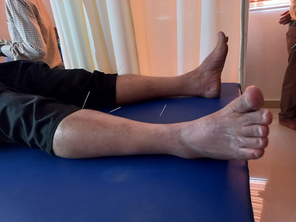 Bangalore Acupuncture Specialists