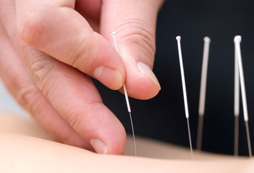 Acupuncture in Bangalore