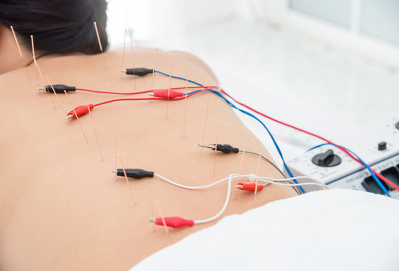 Electro-Acupuncture in Bangalore